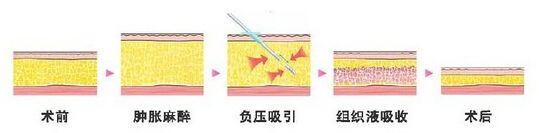 温岭美诺整形水动力吸脂