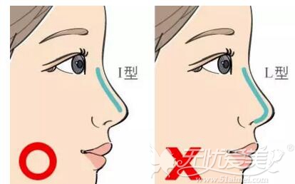 L型假体隆鼻和I型假体隆鼻
