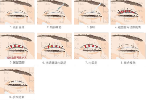 包头联合丽格韩式双眼皮手术方法