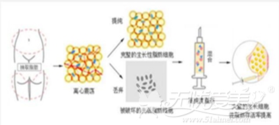 卓颜蕊丽自体脂肪丰胸整形