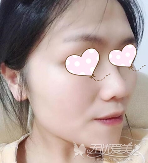上海第九医院硅胶假体隆鼻术后13天