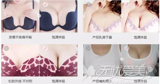 上海美莱隆胸案例