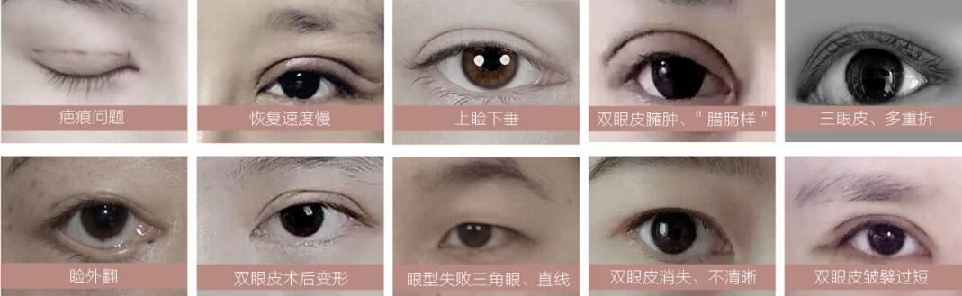 北京瑞丽天承动态微切双眼皮修复术适合类型