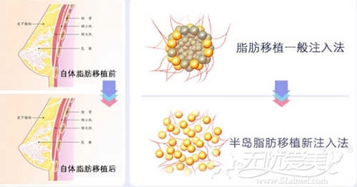 长沙半岛自体脂肪移植丰胸