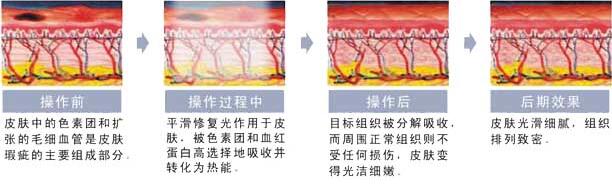 新余嘉和光子嫩肤原理