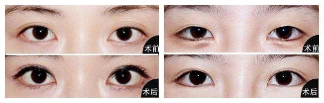 上海清沁双眼皮手术案例