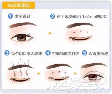 萍乡恒生韩式双眼皮手术步骤