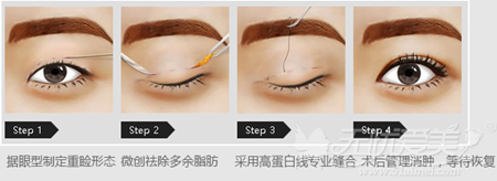 赣州韩美韩式双眼皮手术过程