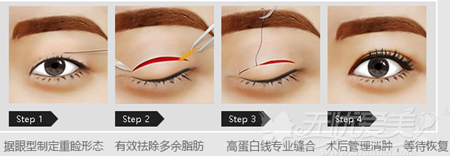 赣州韩美双眼皮定位手术方法