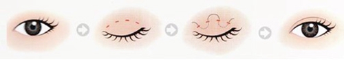 大同美神韩式双眼皮可以改善不对称眼睛