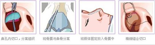 济南星范假体隆鼻手术过程