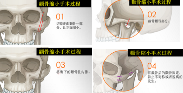 韩国GNG颧骨整形手术过程