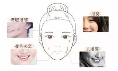 成都格莱丽酒窝形成术