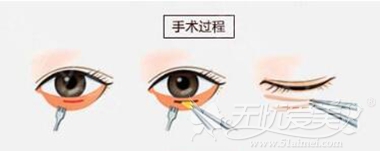 北京善诚卉去眼袋手术