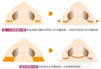 梅河口市百颜鼻翼宽大伴随鼻孔大的手术方法