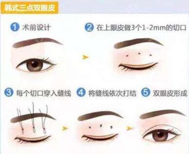 长春海茵韩式三点双眼皮手术方法
