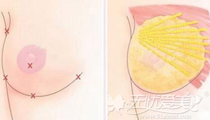 海南瑞韩自体脂肪丰胸手术做的怎么样?哺乳期可以手术吗?
