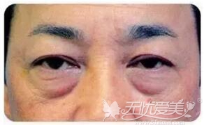 广州名韩外路法去眼袋适应症