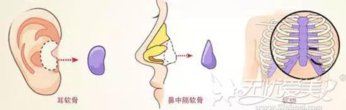 自体软骨隆鼻材料