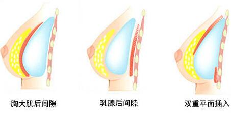 上海曙光假体隆胸手术假体植入层次