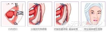 长春子田医疗整形下颌角的口腔手术方法
