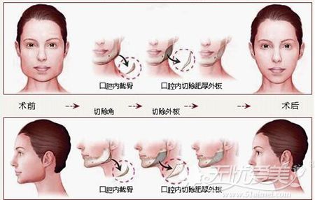 长春子田医疗整形下颌角的手术方法