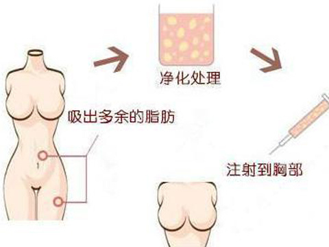 广州柏美自体活细胞丰胸手术