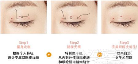 长春邢文明整形医院韩式双眼皮的手术方法