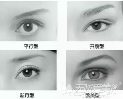双眼皮手术类型