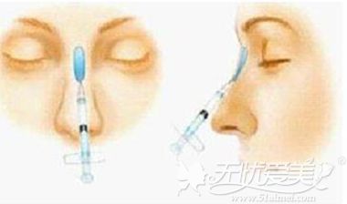 注射玻尿酸隆鼻的手术