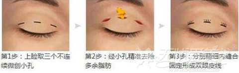 南京韩辰韩式双眼皮的手术方法