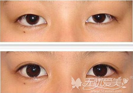 南京韩辰韩式双眼皮整形案例