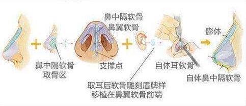 北京科彦鼻综合手术过程