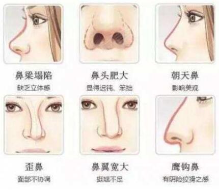 北京科彦鼻综合手术可以改善鼻型