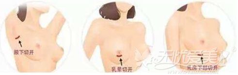 宁波韩美假体隆胸的三种手术方法