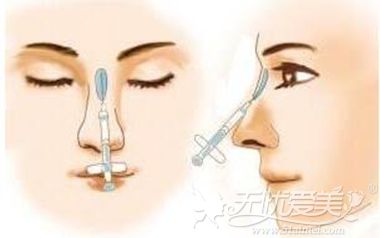 长春绿丹兰注射玻尿酸隆鼻的手术方法