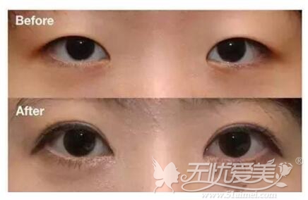 通辽迪尔美和整形韩式双眼皮手术