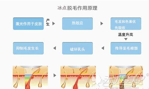 激光脱毛原理