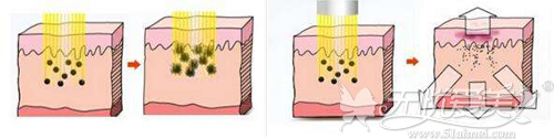 激光祛斑原理