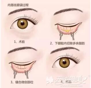 北京溪峰聚美仕内眼角去眼袋的手术方法