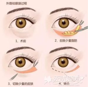 北京溪峰聚美仕开外眼角去眼袋的手术方法