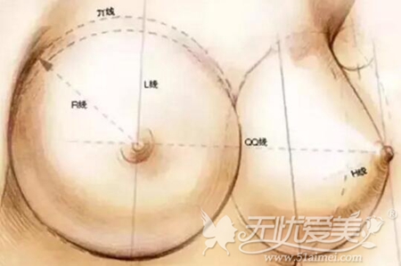 深圳多米勒定制隆胸手术