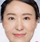 广州曙光本院护士亲自体验韩式双眼皮手术 前后对比照分享