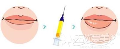 北海李鑫注射玻尿酸丰唇的方法