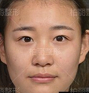 她在北京柏丽整形做双眼皮手术修复 看看变化有多大
