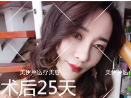 昆明美伊莱做的综合隆鼻术后25天