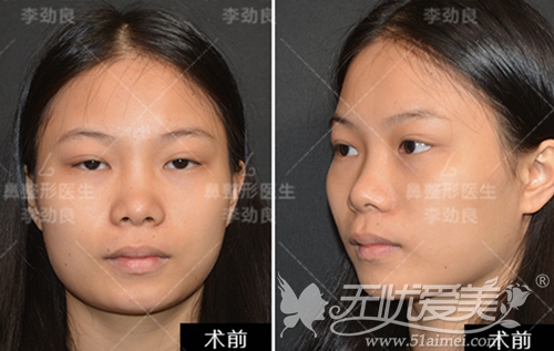 在北京柏丽做面部脂肪填充+鼻综合+瘦脸针术前