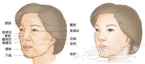 西安哪个医院做面部脂肪填充好 这个月有优惠吗?