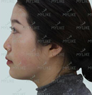 分享我在云南华美美莱做的达拉斯隆鼻+艺术面雕后的效果