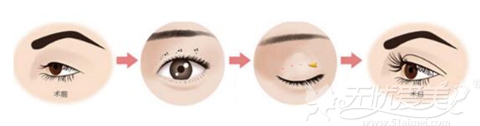 广州瓷肌埋线双眼皮手术方法